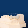 Customized Crown Porcelain Fused to Metal